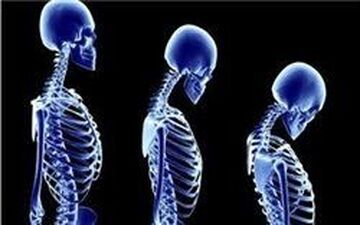 شانه‌های یخ زده |  بیماری شانه‌‌های یخ زده چیست و چه علائمی دارد؟