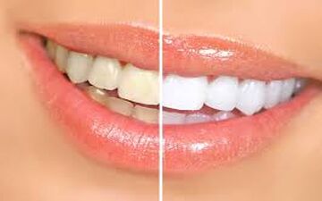 
برطرف کردن جرم دندان با روش‌های طبیعی
