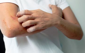 خارش مزمن بدن؛مسئله ای که باید جدی گرفته شود