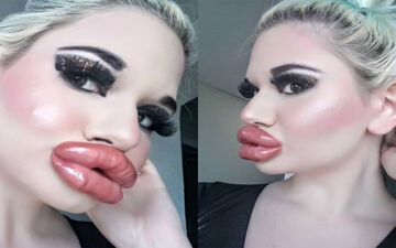 صاحب بزرگ‌ترین لب‌های دنیا به دنبال بزرگ‌تر کردن لب هایش است
