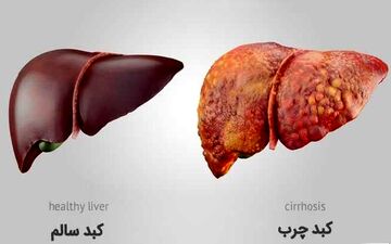 پایان کبد چرب/ قدرت شگفت‌انگیز انتخاب‌های روزمره شما!