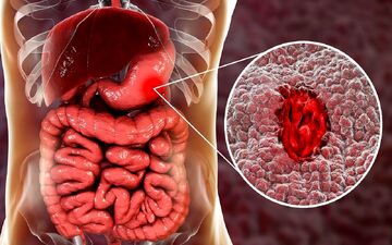 نقش رژیم غذایی در کاهش خطر سرطان معده