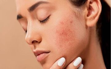 این اشتباهات لکه‌های صورت را بدتر می‌کنند؛ مراقب پوستتان باشید!