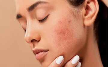 این اشتباهات لکه‌های صورت را بدتر می‌کنند؛ مراقب پوستتان باشید!