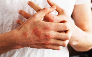 علائم شروع بیماری خودایمنی