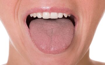 دلیل خشک شدن دهان دیابتی ها چیه؟