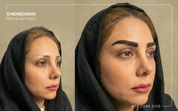 سن مناسب برای کاشت ابرو؛ آیا در سنین بالا امکان‌پذیر است؟