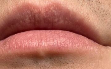  لکه های سفید روی لب چه دلیلی دارند؟

