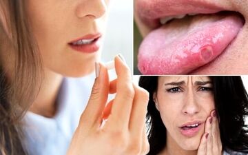 زخم های دهان را چگونه درمان کنیم؟