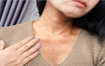 خطرناک‌ترین نشانه مصرف زیاد قند چیست؟ مراقب این تغییر عجیب پوستی باشید