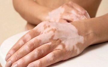 نکات بسیار مهم درباره لک‌های پوستی که تا الان نمی دانستید
