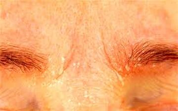 شوره ابرو چیست؟ + درمان و علل آن