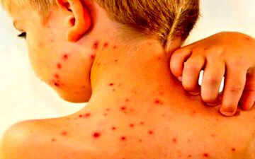 کاهش میزان واکسیناسیون آمار ابتلا به سرخک را افزایشی کرد