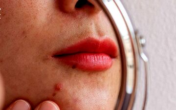 این کارها باعث تشدید جوش‌های صورت می‌شوند