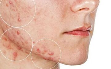 برای سلامت پوست چکار کنیم؟| لمس صورت باعث بروز و یا تشدید آکنه می شود؟