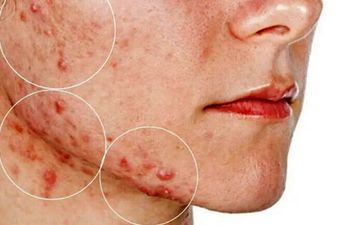 برای سلامت پوست چکار کنیم؟| لمس صورت باعث بروز و یا تشدید آکنه می شود؟