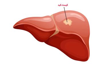 خطر سرطانی شدن کیست‌های کبدی چقدر است؟