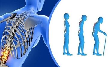 از پوکی استخوان چگونه می توان جلوگیری کرد؟

