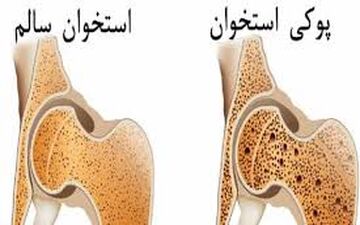 با این 6 عادت پوکی استخوان را از خود دور کنید