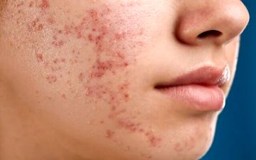 اثرات رژیم غذایی بد روی پوست