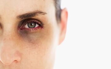 نگاهی به علل تیرگی دور چشم و درمان آن