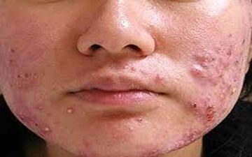 اگه نمی دونی چرا پوستت پراز جوش و آکنه است اینجا بهت میگم دلیلش چیه!