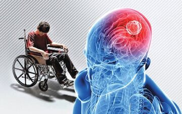 علائم هشدار دهنده بیماری ام اس