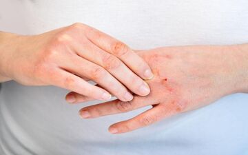 تسکین اگزما با طب سنتی/مواد غذایی مفید و مضر را بدانید