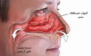 ترشح پشت حلق و 5 روش برای توقف آن