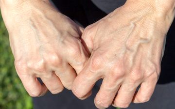 چه زمانی نمایان شدن رگ‌ها طبیعی است و چه زمانی نشانه بیماری؟