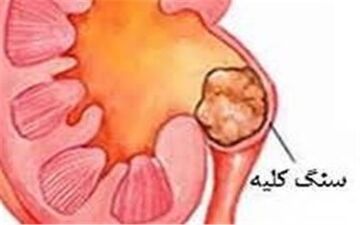  این خوراکی ها سبب سنگ کلیه می شوند 