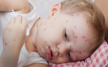 این علائم گویای ابتلا به مخملک است/مخملک هنوز کشنده است؟