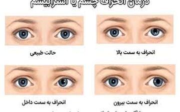 انحراف چشم مخفی و این درمان ها