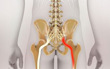 آموزش حرکات اصلاحی ساده برای تسکین درد سیاتیک (+ویدئو)