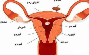 مهمترین دانستنی ها در مورد فیبروم رحمی!