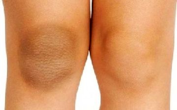 زانو و آرنج‌ات تیره شده؟ بیا تا قوی‌ترین لایه‌بردار رو بهت معرفی کنم!