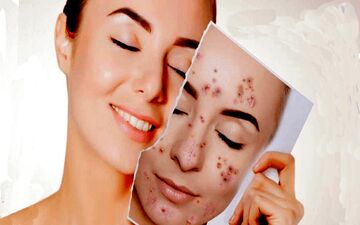 روش‌های خانگی برای درمان سریع جوش و التهاب پوست صورت