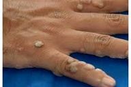 در مورد  ویروس HPV را حتما بشناسید چون احتمال ابتلا به آن بسیار بالاست!
