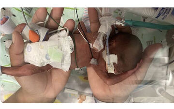 در گینس ثبت شد؛ تولد نارس‌ترین نوزاد دنیا در 21 هفتگی!