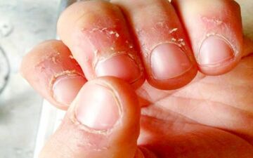 سرطان سینه چگونه بر پوست و ناخن شما تأثیر می گذارد؟