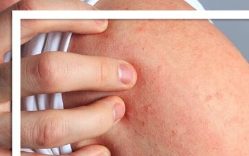 چرا استرس باعث بروز کهیر می شود؟