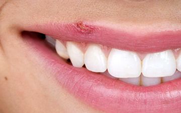 خانم‌های زیبا و حساس نگران تبخال زدن نباشید | این ویتامین‌ها را مصرف کن تا تبخال نزنی!