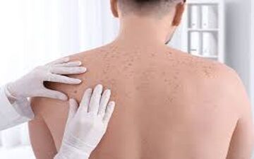  سرطان پوست؛ علل، پیشگیری و رژیم غذایی