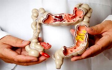 چند راهکار طب سنتی برای درمان یبوست

