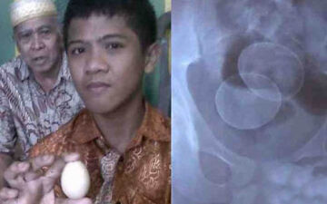 پسری که مانند مرغ، تخم می‌گذارد!