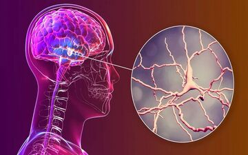 نتایج امیدوارکننده یک ساختار نانویی برای مقابله با پارکینسون

