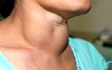 روش های تشخیص سرطان تیروئید