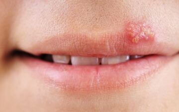 تبخال را سه دقیقه ای از بین ببرید