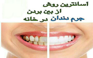  جرم گیری دندان ها در منزل؟!