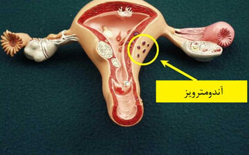 علائم آندومتریوز چیست؟